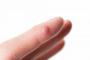指のイボを治す5つの方法