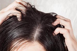 頭皮の真菌感染症に効果のある自然療法6選