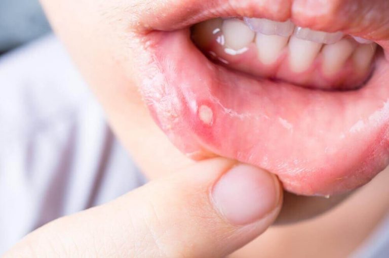 口内炎を治療する7つの自然療法