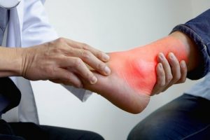 炎症に効く自然治療薬