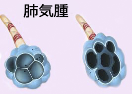 肺気腫