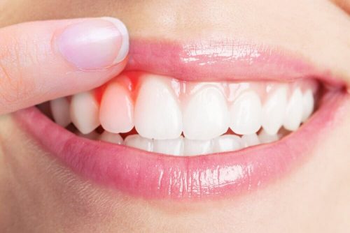 歯周病の自然療法トップ５