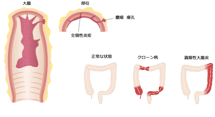 クローン病