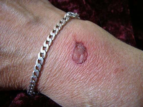 やけどの種類と症状