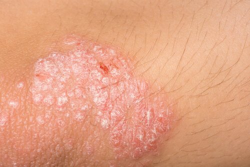 皮膚炎の症状を緩和する自然療法