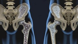 骨粗しょう症を予防する食生活の6つのヒント