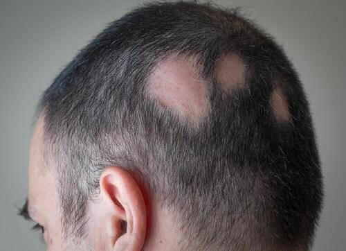 脱毛症に効果的な自然療法
