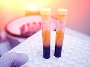 血小板の数を増やす効果が期待できる4つの自然療法
