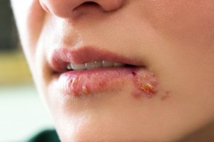 子供のヘルペス 対処法