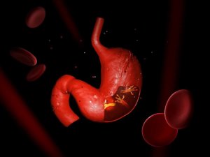 ピロリ菌と闘うためのハーブ療法