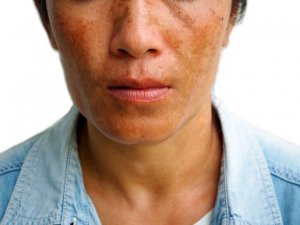 黒皮症の軽減に役立つ3つの治療法