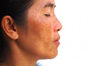 黒皮症におすすめ ヨーグルト、バナナ、レモンを使った自然療法