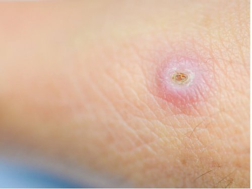 おできを防ぐ方法