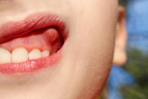 歯の膿瘍に役立つ自然療法10選