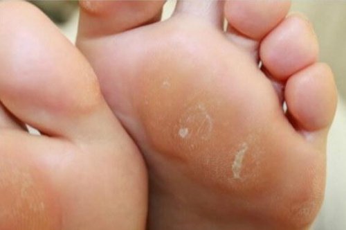 足のタコに効果を発揮する玉ねぎとホワイトビネガーの自然療法