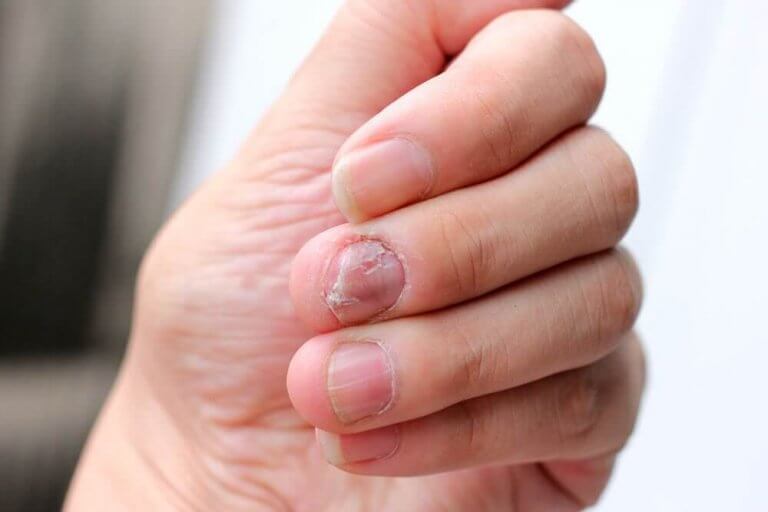 爪乾癬に効く5つの自然療法