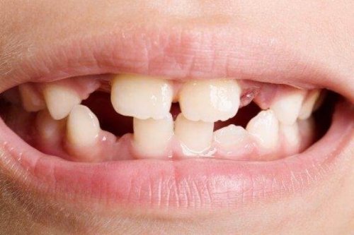 歯の形成障害  種類と治療法