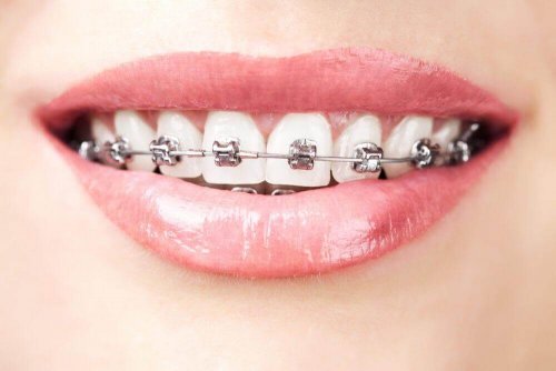 歯列矯正 歯の形成障害