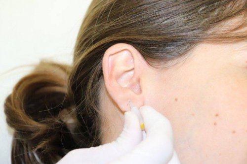 耳介治療