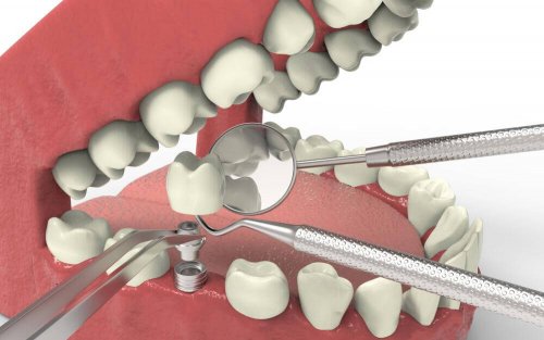 インプラント 歯の形成障害