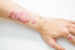 腕の乾癬　乾癬の治療に役立つハーブ