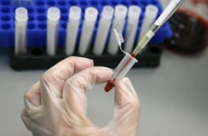 幹細胞移植はHIVを根絶することができるのか?