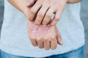 局所的な乾癬の治療に役立つハーブ5種