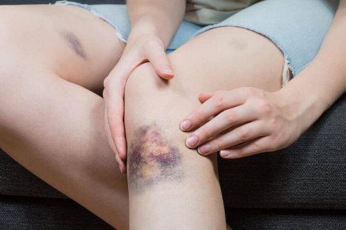青あざを早く治す5つの自然療法