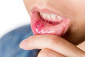 口内炎の予防
