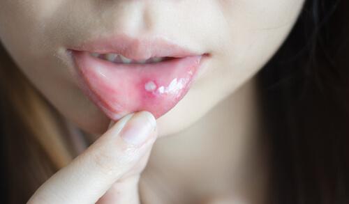 口内炎や口の中の痛みを和らげる方法
