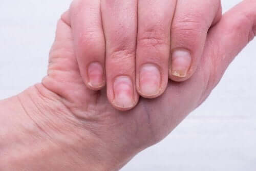 爪の黄ばみを解消したい！効果的な３つの自然療法