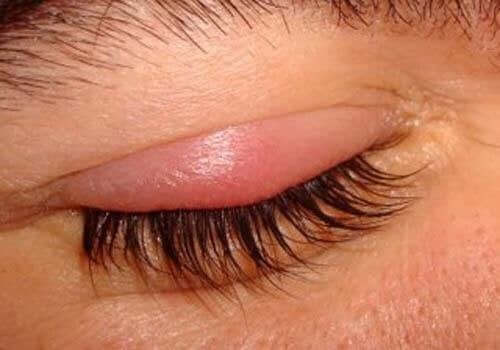 眼瞼炎の原因