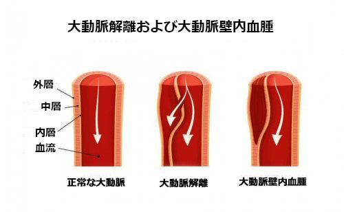 大動脈解離