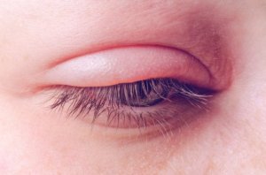 眼瞼炎：原因、症状、治療法