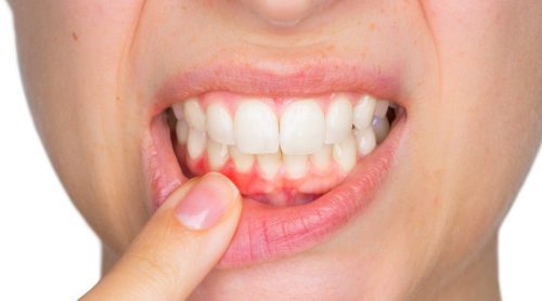 歯の膿瘍と治療法