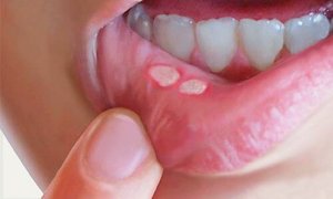 口内炎を自宅で治そう!