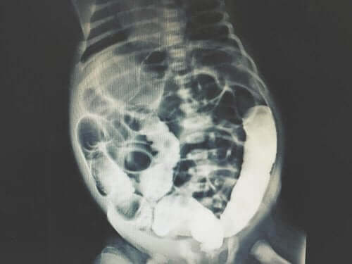レントゲン 診断的腹腔洗浄