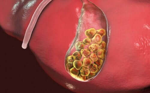 胆石ができるまで