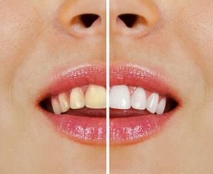 天然素材を使った歯のホワイトニング法