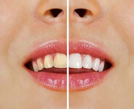 天然素材を使った歯のホワイトニング法