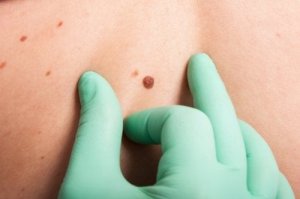 皮膚がんを見分けるためのABCDEルール