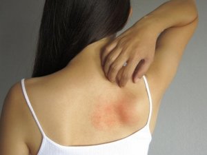 発疹を緩和するのに役立つ5つの天然の外用薬