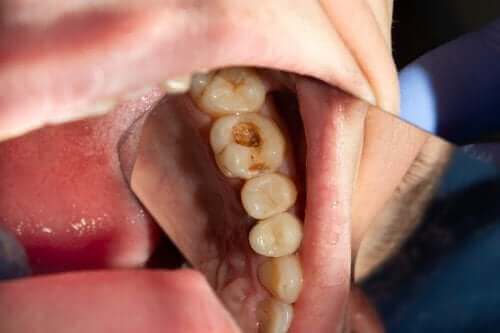 虫歯の原因とは？