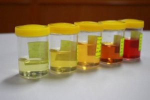 尿の異常に関するすベてを学ぼう!