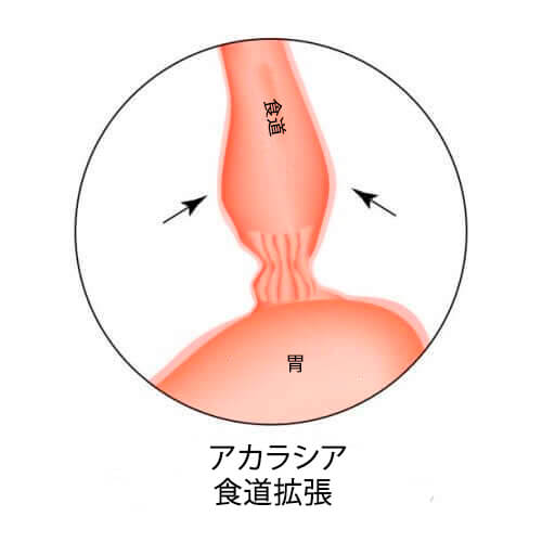 アカラシア
