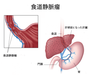 危険! 食道静脈瘤の兆候と症状とは?