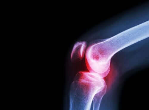 非ステロイ ド抗炎症薬：アセクロフェナクの効果について　膝の関節リウマチ
