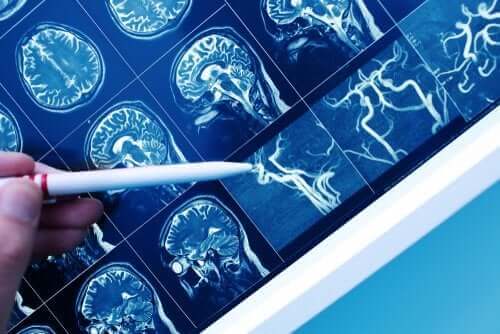 脳血管性認知症の原因、症状、治療法