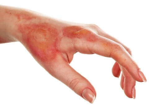 軽度の火傷：浅達性熱傷の治療方法　火傷をした手
