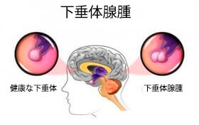 下垂体腺腫:その原因と症状